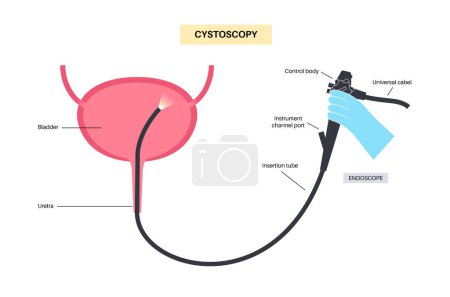 Cystoscopy is a minimally invasive procedure. Examination and treatment of the bladder. Disorder of the urinary system, cancer, polyps, stones or inflammation. Urinary tract medical poster flat vector