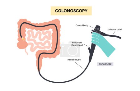 La colonoscopia es un procedimiento mínimamente invasivo. Examen y tratamiento del intestino grueso. Trastorno del colon, pólipos, inflamación o hinchazón del intestino. Trastorno gastrointestinal vector plano