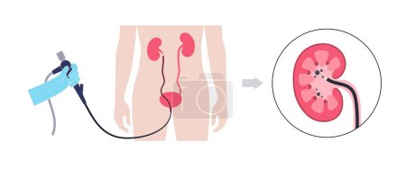 Ilustración de La ureteroscopia es un procedimiento mínimamente invasivo. Examen y tratamiento del riñón. Trastorno del sistema urinario, cáncer, pólipos, cálculos o inflamación. Póster del vector médico del tracto urinario - Imagen libre de derechos