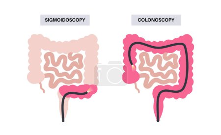 Colonoscopy and sigmoidoscopy test. Examination and treatment of the large intestine. Disorder of the colon, inflammatory bowel disease, constipation or incontinence. Gastrointestinal medical vector