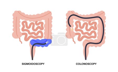 Ilustración de Prueba de colonoscopia y sigmoidoscopia. Examen y tratamiento del intestino grueso. Trastorno del colon, enfermedad inflamatoria intestinal, estreñimiento o incontinencia. Vector médico gastrointestinal - Imagen libre de derechos
