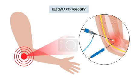Illustration for Elbow joint minimally invasive surgery. Arthroscopy medical procedure. Anatomy of humerus, ulna and radius bones. Arm pain, fracture, osteoarthritis or rheumatoid arthritis x ray vector illustration - Royalty Free Image