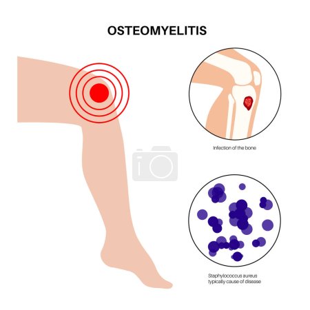 Illustration for Osteomyelitis disease. Infected knee, dead bones, pain and overlying redness. Infection spreads through the bloodstream into tibia. Staphylococcus aureus bacteria in the human body vector illustration - Royalty Free Image