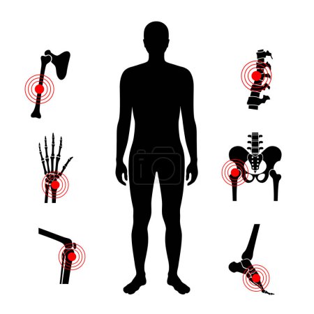 Illustration for Disease of human bones and joints. Inflamed spine, arm, leg and hip. Trauma, injury, infection or fractures in the male silhouette, examination of the human body, surgery and treatment medical vector - Royalty Free Image