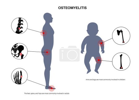 Illustration for Osteomyelitis disease in adults and children. Infected bones of spine, legs and arms. Infection spreads through the bloodstream into the bones. Staphylococcus aureus bacteria in the human body vector. - Royalty Free Image
