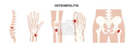 Illustration for Osteomyelitis disease, common cases. Infected bones of spine, arm, leg and hip. Infection spreads through the bloodstream into the bone tissue. Staphylococcus aureus bacteria in the human body vector. - Royalty Free Image