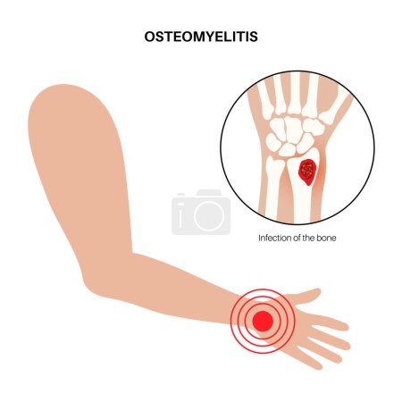 Illustration for Osteomyelitis disease. Infected arm bones, pain and overlying redness. Infection spreads through the bloodstream into the wrist. Staphylococcus aureus bacteria in the human body vector illustration - Royalty Free Image