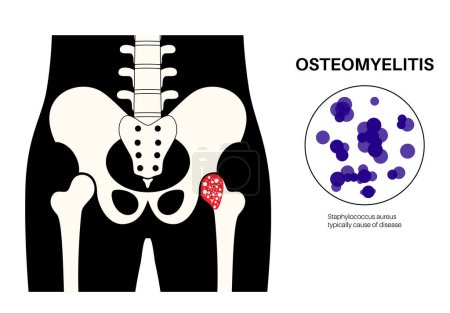 Illustration for Osteomyelitis disease. Infected hip, pain and overlying redness. Infection spreads through the bloodstream into the femur bone. Staphylococcus aureus bacteria in the human body vector illustration - Royalty Free Image