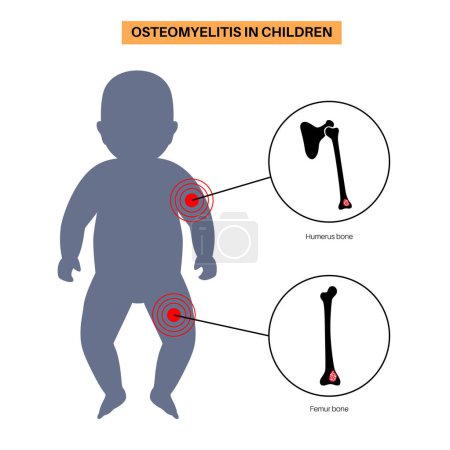 Illustration for Osteomyelitis disease in children common cases. Infected bones of arms and legs. Infection spreads through the bloodstream into the humerus and femur bones. Bacteria in the infant body, medical vector - Royalty Free Image