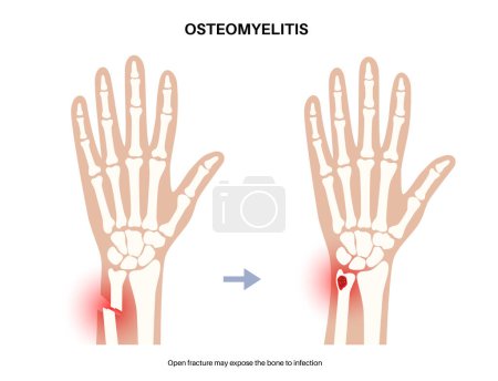 Illustration for Osteomyelitis disease. Infected arm bones, pain and overlying redness. Infection spreads through the bloodstream into the wrist. Staphylococcus aureus bacteria in the human body vector illustration - Royalty Free Image