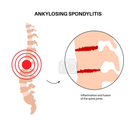 Illustration for Ankylosing spondylitis. Arthritis that causes inflammation in the joints and ligaments of the spine. Inflamed and fusion vertebrae in the spinal column. Hip and lower back pain vector illustration - Royalty Free Image