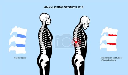 Téléchargez les illustrations : Spondylarthrite ankylosante. Arthrite qui provoque une inflammation des articulations et des ligaments de la colonne vertébrale. Vertèbres enflammées et fusionnées dans la colonne vertébrale. Illustration vectorielle des douleurs de la hanche et du bas du dos - en licence libre de droit