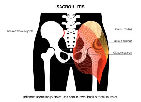Illustration for Sacroiliitis disease concept. Inflamed sacroiliac joints. Lower spine and pelvis inflammatory connection. Pain, stiffness in the gluteal muscles and lower back, anatomical flat vector illustration - Royalty Free Image