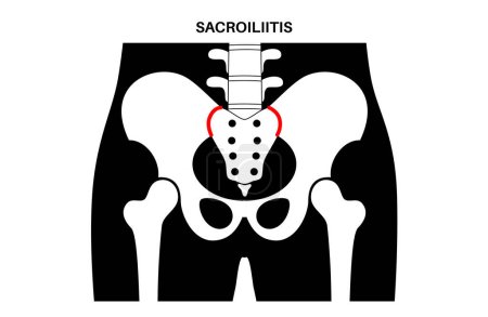 Illustration for Sacroiliitis disease concept. Inflamed sacroiliac joints. Lower spine and pelvis inflammatory connection. Pain, stiffness in the buttocks or lower back, sacrum problem, anatomical vector illustration - Royalty Free Image