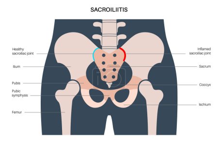 Illustration for Sacroiliitis disease concept. Inflamed sacroiliac joints. Lower spine and pelvis inflammatory connection. Pain, stiffness in the buttocks or lower back, sacrum problem, anatomical vector illustration - Royalty Free Image