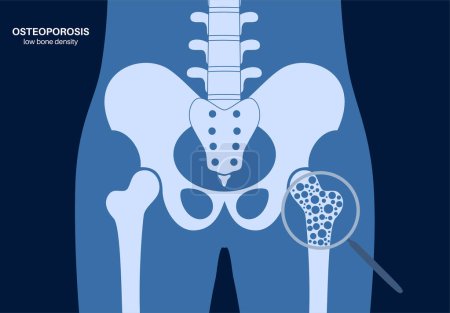 Osteoporosis disease. Systemic skeletal disorder, loss of bone mineral density. Increased risk of hip fracture, morbidity and mortality in the elderly. Deterioration of bone tissue vector illustration