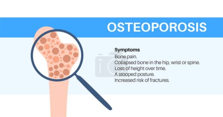 Illustration for Osteoporosis disease. Systemic skeletal disorder, loss of bone mineral density. Increased risk of hip fracture, morbidity and mortality in the elderly. Deterioration of bone tissue vector illustration - Royalty Free Image