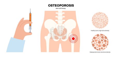 Illustration for Osteoporosis disease, stem cell treatment, reduce pain, improve mobility. Systemic skeletal disorder, loss of bone mineral density in the human body. Deterioration of bone tissue vector illustration. - Royalty Free Image