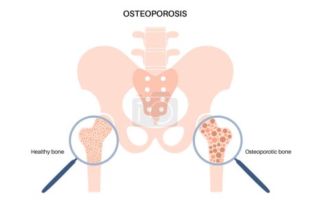 Illustration for Osteoporosis disease poster. Systemic skeletal disorder, loss of bone mineral density. Normal and unhealthy bones. Increased risk of hip fracture. Deterioration of bone tissue flat vector illustration - Royalty Free Image