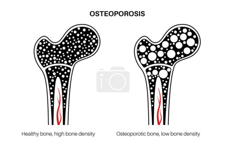 Illustration for Osteoporosis disease poster. Systemic skeletal disorder, loss of bone mineral density. Normal and unhealthy bones. Increased risk of hip fracture. Deterioration of bone tissue flat vector illustration - Royalty Free Image