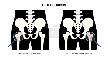 Plakat zur Osteoporose-Erkrankung. Systemische Skelettstörung, Verlust der Knochenmineraldichte. Normale und ungesunde Knochen. Erhöhtes Risiko eines Hüftbruchs. Verschlechterung des flachen Vektors im Knochengewebe
