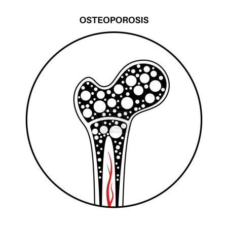 Illustration for Osteoporosis disease. Systemic skeletal disorder, loss of bone mineral density. Increased risk of hip fracture, morbidity and mortality in the elderly. Deterioration of bone tissue vector illustration - Royalty Free Image