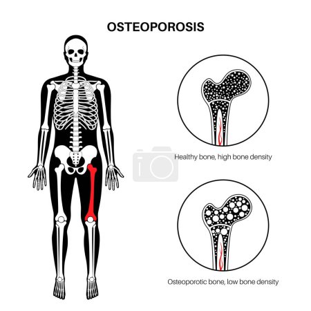 Illustration for Osteoporosis disease. Systemic skeletal disorder, loss of bone density. Normal and unhealthy bones in the human body. Increased risk of fractures. Deterioration of bone tissue vector flat illustration - Royalty Free Image