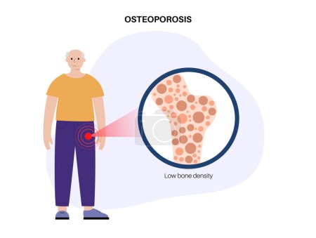 Illustration for Osteoporosis disease concept. Systemic skeletal disorder, loss of bone mineral density. Increased risk of hip fracture in older men. Morbidity and mortality in the elderly, flat vector illustration - Royalty Free Image