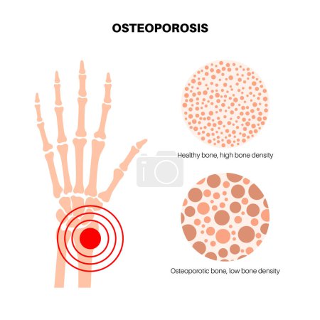 Illustration for Wrist osteoporosis disease poster. Systemic skeletal disorder, loss of bone mineral density. Normal and unhealthy bones. Increased risk of fractures. Deterioration of bone tissue vector illustration - Royalty Free Image