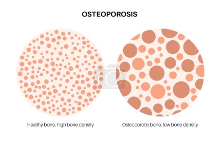 Téléchargez les illustrations : Affiche sur la maladie d'ostéoporose. Trouble squelettique systémique, perte de densité minérale osseuse. Os normaux et malsains. Risque accru de fracture de la hanche. Détérioration du tissu osseux illustration vectorielle plate - en licence libre de droit