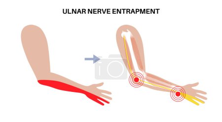 Illustration for Ulnar nerve entrapment. Cubital tunnel syndrome and Guyons canal syndrome. Pressure or pulling, stretching of the ulnar nerve in the elbow and wrist regions. Pain in arm anatomical vector illustration - Royalty Free Image