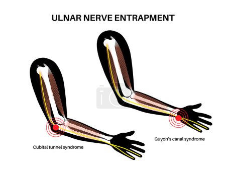 Illustration for Ulnar nerve entrapment. Cubital tunnel syndrome and Guyons canal syndrome. Pressure or pulling, stretching of the ulnar nerve in the elbow and wrist regions. Pain in arm anatomical vector illustration - Royalty Free Image