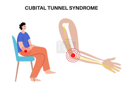 Illustration for Cubital tunnel syndrome . Pressure or pulling and stretching of the ulnar nerve in the elbow region. Common peripheral neuropathy that affects upper limbs, pain in arms anatomical vector illustration - Royalty Free Image
