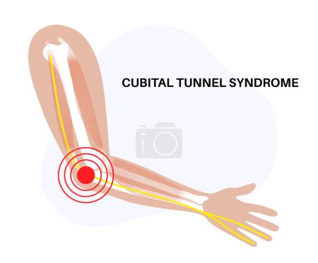Cubital tunnel syndrome . Pressure or pulling and stretching of the ulnar nerve in the elbow region. Common peripheral neuropathy that affects upper limbs, pain in arms anatomical vector illustration