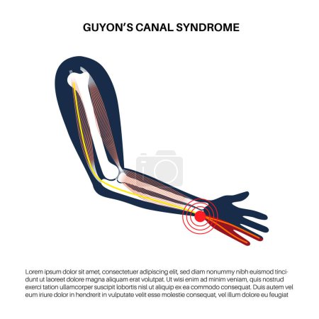 Illustration for Guyons canal syndrome. Pressure or pulling and stretching of the ulnar nerve in the wrist region. Common peripheral neuropathy that affects upper limbs, pain in arms anatomical vector illustration - Royalty Free Image