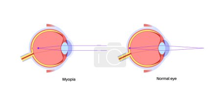 Illustration for Nearsightedness eye disease poster. Myopia or short sightedness refractive error concept, problem of blurred vision. Anatomy of human eye infographic, lens and retina medical flat vector illustration - Royalty Free Image