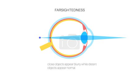 Illustration for Farsightedness eye disease poster. Hyperopia or long sightedness refractive error concept, problem of blurred vision. Anatomy of human eye, lens and retina, hypermetropia medical vector illustration - Royalty Free Image