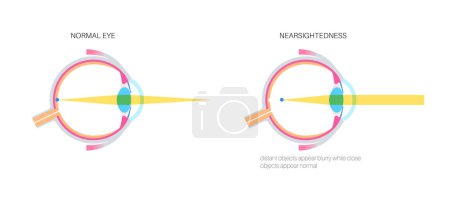 Illustration for Nearsightedness eye disease poster. Myopia or short sightedness refractive error concept, problem of blurred vision. Anatomy of human eye infographic, lens and retina medical flat vector illustration - Royalty Free Image