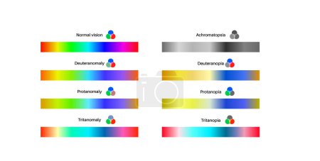 Color blindness infographic. Vision deficiency concept. Difference between colors. Deuteranomaly deuteranopia and protanomaly. Protanopia, tritanopia and tritanomaly. Achromatopsia vector illustration
