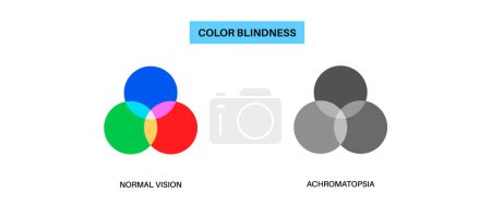 Ilustración de Acromatopsia y visión normal, infografía de daltonismo. Concepto de deficiencia de visión humana. Diferencia entre colores, brillo e intensidad de los tonos. Anomalía ocular ilustración vectorial plana - Imagen libre de derechos