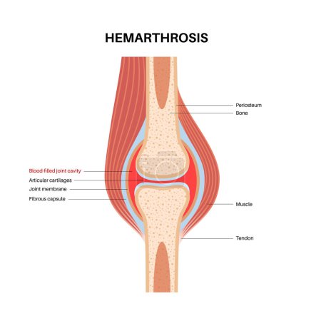 Illustration for Hemarthrosis disease medical poster, bleeding inside of the synovial joints. A physical examination in an orthopedic clinic. Blood in joint cavity, hemophilia pain, swelling in leg vector illustration - Royalty Free Image