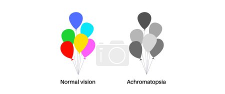 Ilustración de Acromatopsia y visión normal, infografía de daltonismo. Concepto de deficiencia de visión humana. Diferencia entre colores, brillo e intensidad de los tonos. Anomalía ocular ilustración vectorial plana - Imagen libre de derechos