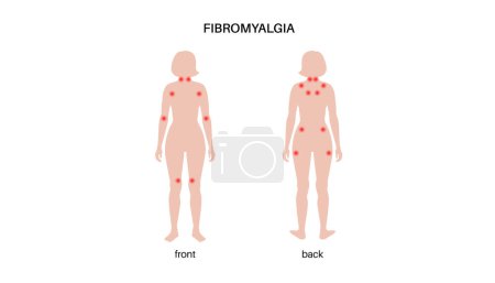 Fibromyalgia in the female body. Chronic widespread pain in joints muscles, fatigue and cognitive symptoms. Musculoskeletal disease. Red points in woman silhouette medical flat vector illustration.