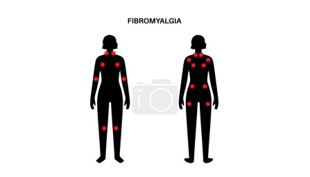 Fibromialgia en el cuerpo femenino. Dolor crónico generalizado en los músculos de las articulaciones, fatiga y síntomas cognitivos. Enfermedad musculoesquelética. Puntos rojos en la silueta de la mujer médica vector plano ilustración.