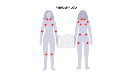 Fibromialgia en el cuerpo femenino. Dolor crónico generalizado en los músculos de las articulaciones, fatiga y síntomas cognitivos. Enfermedad musculoesquelética. Puntos rojos en la silueta de la mujer médica vector plano ilustración.