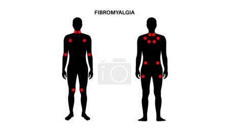 Fibromyalgie dans le corps masculin. Douleur chronique généralisée dans les muscles articulaires, fatigue et symptômes cognitifs. Maladie musculosquelettique. Points rouges dans l'illustration vectorielle plate médicale de silhouette d'homme.