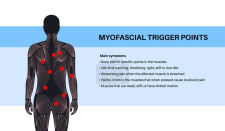 Myofascial trigger points medical poster. MTrPs concept. Hyperirritable spots in the skeletal muscle knots in male silhouette. Red points in sensitive areas on the human body flat vector illustration