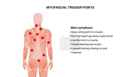Myofaszieller Triggerpunkt medizinisches Plakat. MTrPs Konzept. Hyperreizbare Flecken im Skelettmuskelknoten in der männlichen Silhouette. Rote Punkte in sensiblen Bereichen auf dem flachen Vektorbild des menschlichen Körpers