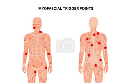 Illustration for Myofascial trigger points medical poster. MTrPs concept. Hyperirritable spots in the skeletal muscle knots in male silhouette. Red points in sensitive areas on the human body flat vector illustration - Royalty Free Image
