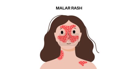 Systemischer Lupus erythematodes medizinisches Poster. Schmetterlings- oder Malarenausschlag auf einem weiblichen Gesicht. Autoimmunkrankheit. Entzündungen und Schädigungen des Hautgewebes, Schmerzen in den inneren Organen Vektor Illustration
